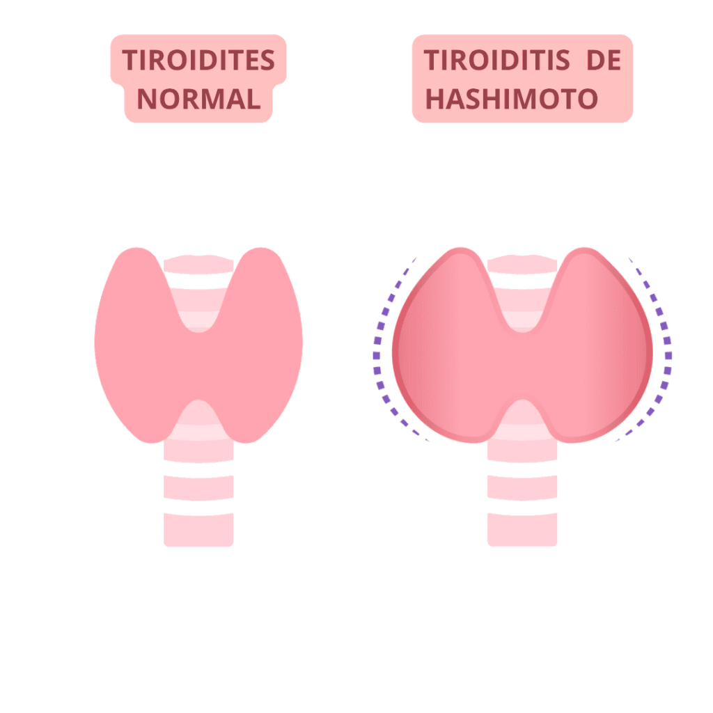 La tiroiditis de Hashimoto