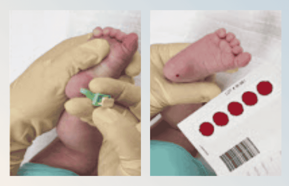 Autoinmune Tiroiditis