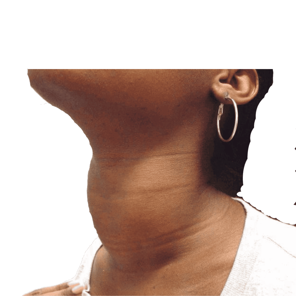 Bocio