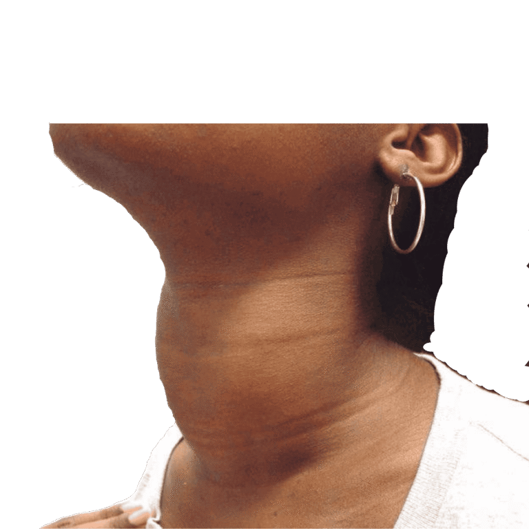 Bocio