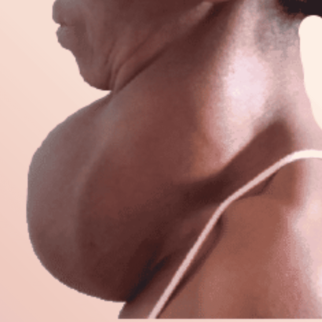 Autoinmune Tiroiditis