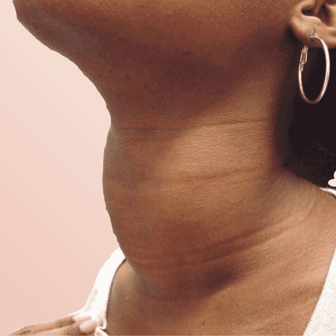 Autoinmune Tiroiditis