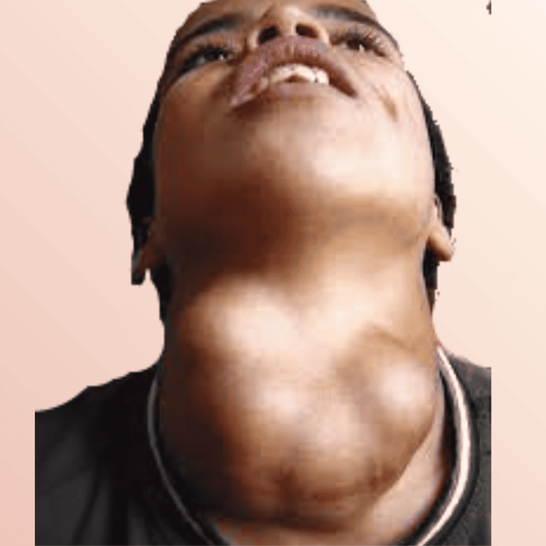 Autoinmune Tiroiditis