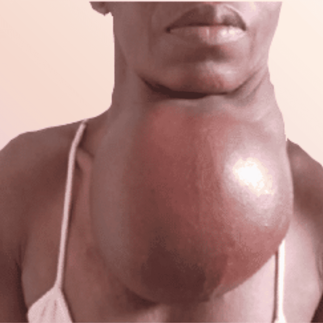 Autoinmune Tiroiditis