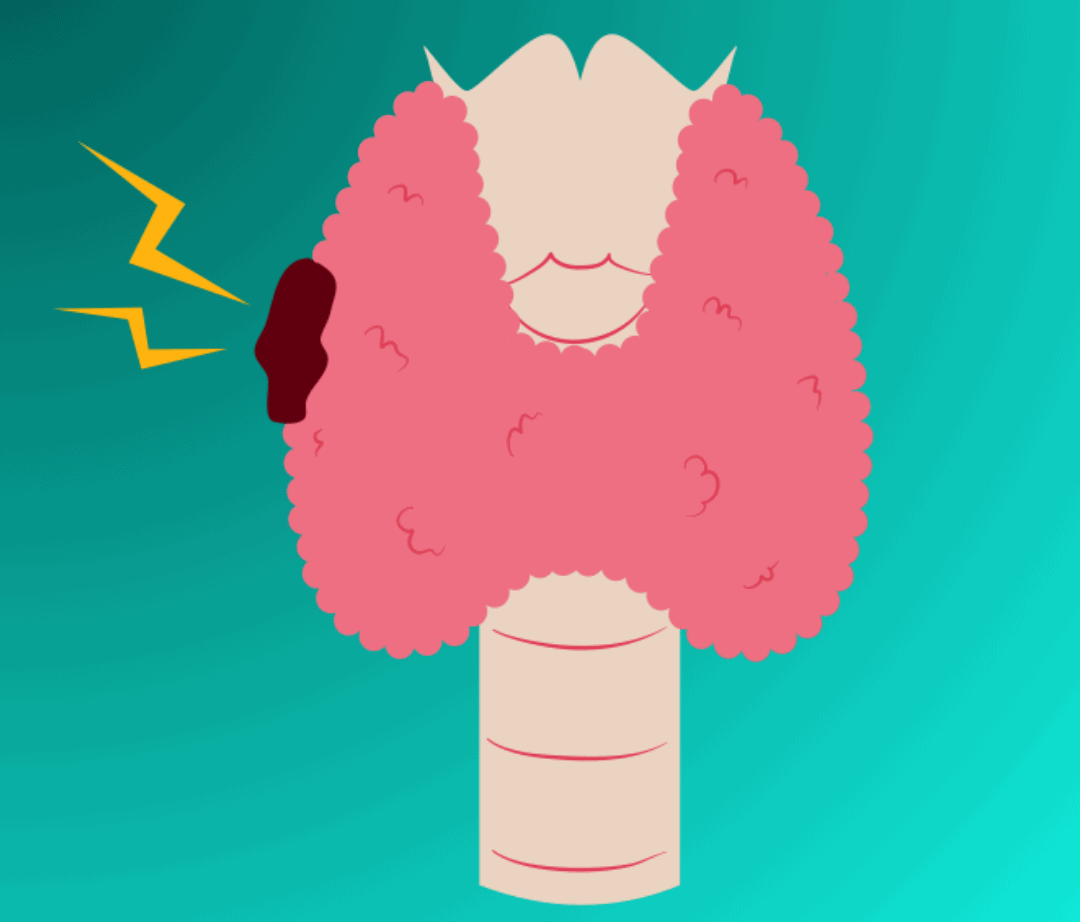 Autoinmune Tiroiditis