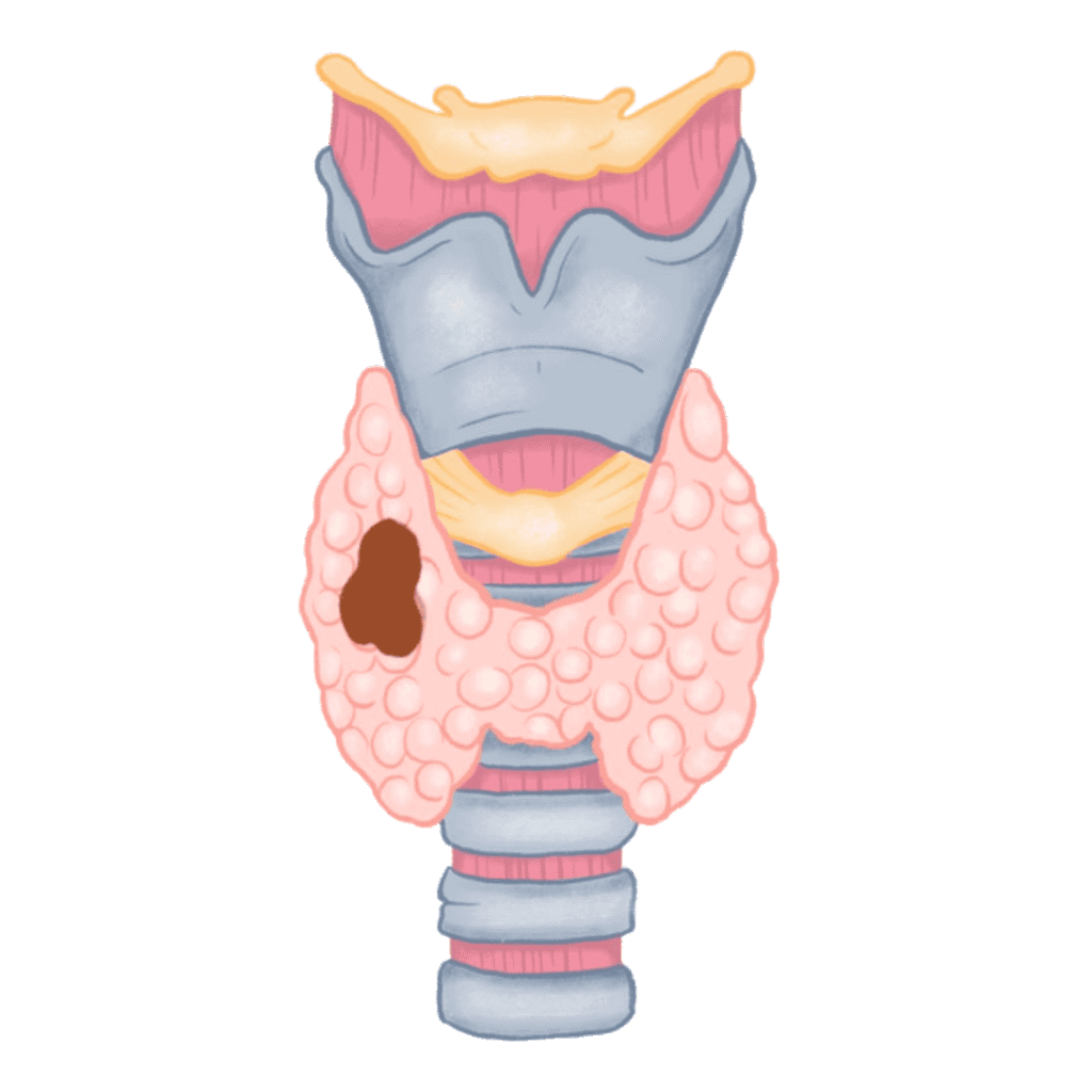 La tiroides Cáncer