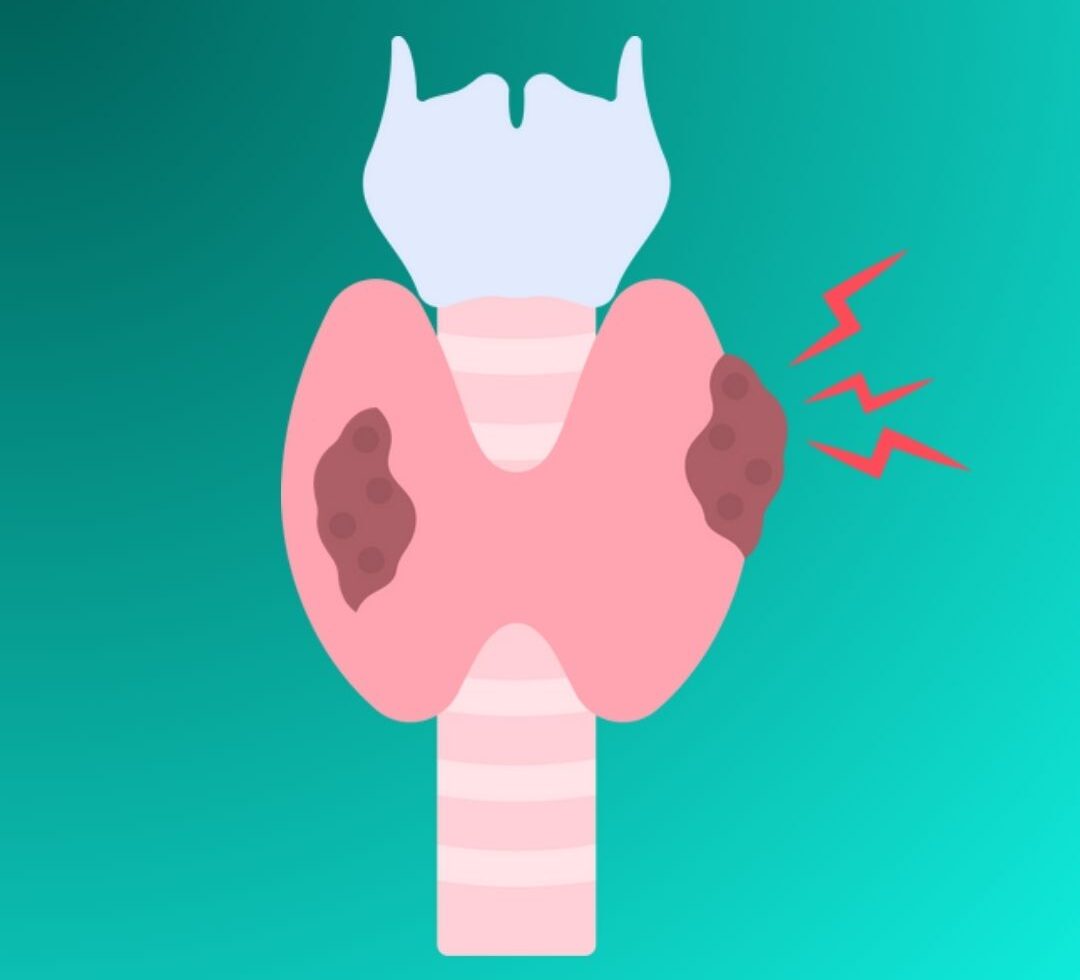 Autoinmune Tiroiditis