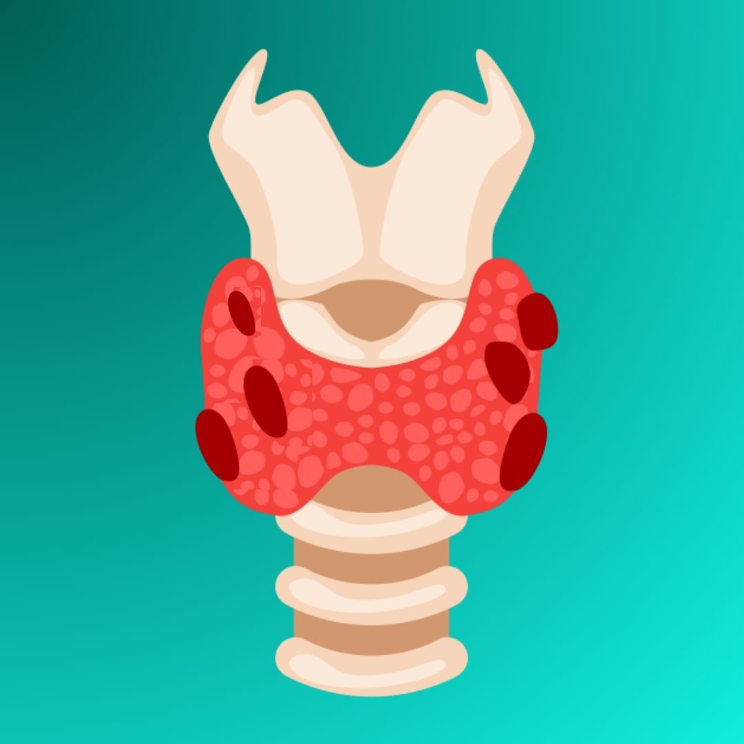 Autoinmune Tiroiditis