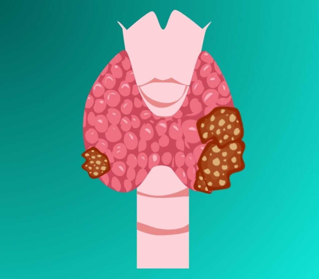 Autoinmune Tiroiditis