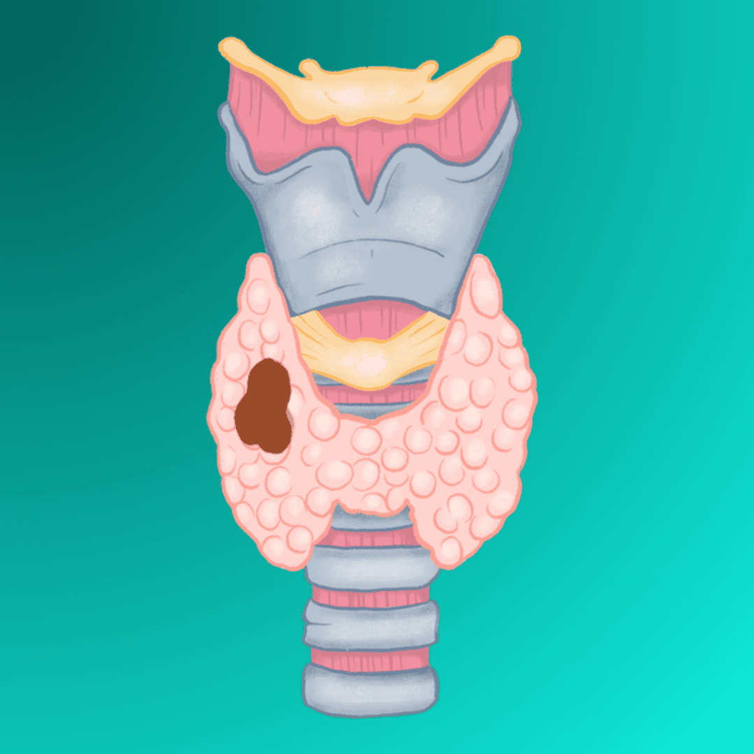 Autoinmune Tiroiditis