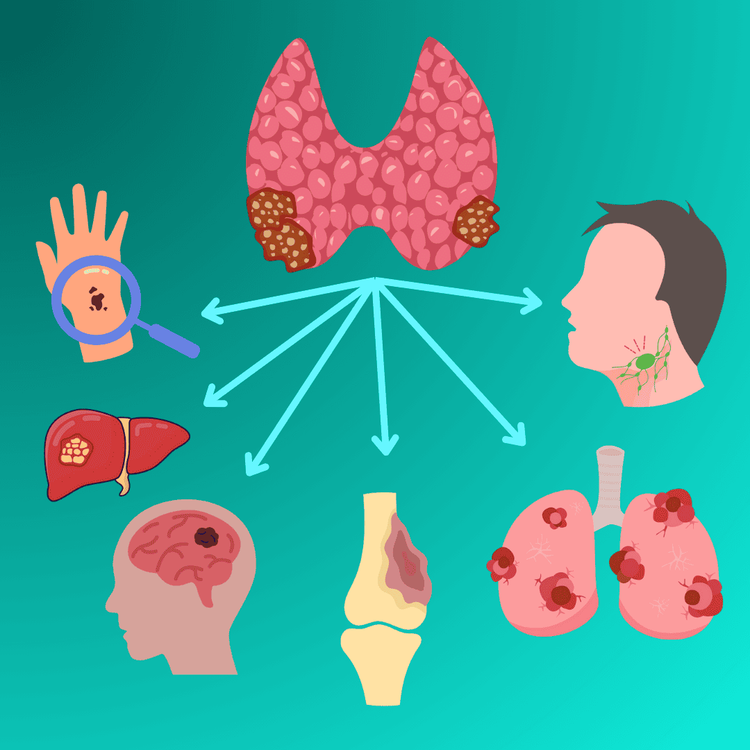 Autoinmune Tiroiditis