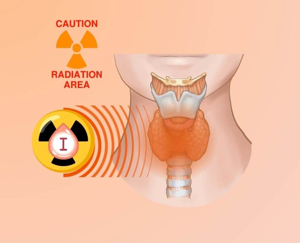 Autoinmune Tiroiditis