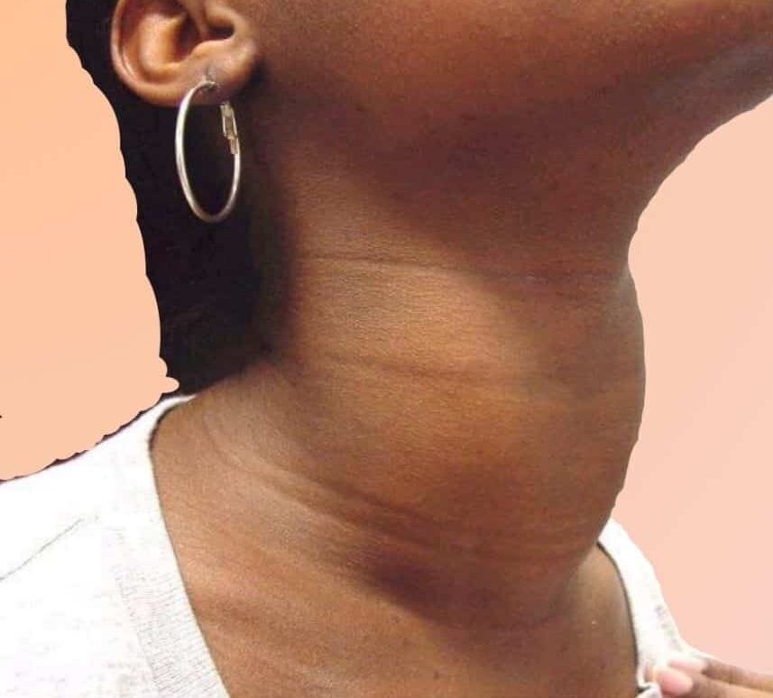 Autoinmune Tiroiditis
